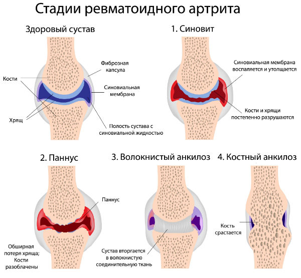 Воспаление суставов