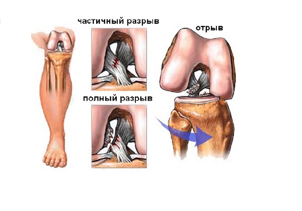 Пластика ПКС, степени разрыва связки Пластика передней крестообразной связки