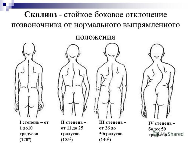 Сколиоз позвоночника