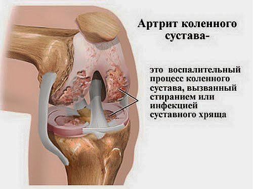 Воспаление суставов