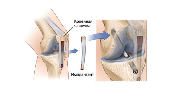 Пластика ПКС: применение трансплантата в операции Пластика передней крестообразной связки