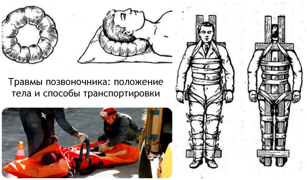 Травма позвоночника