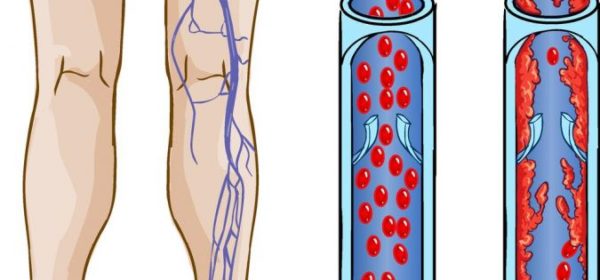Перелом тазобедренного сустава: медикаментозные методы лечения Перелом тазобедренного сустава
