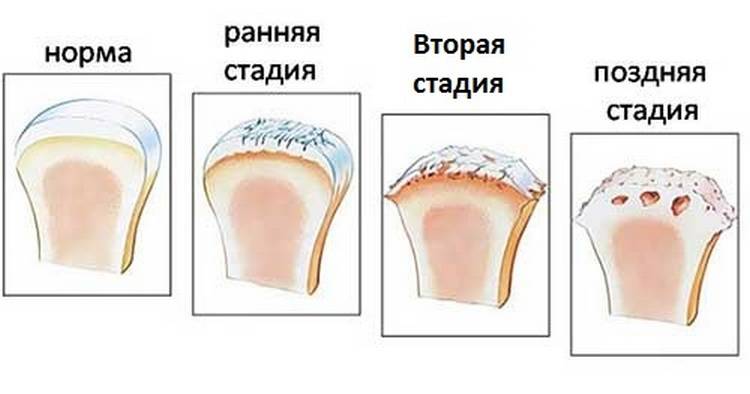 Артроз плечевого сустава