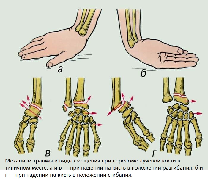 Болят кисти рук