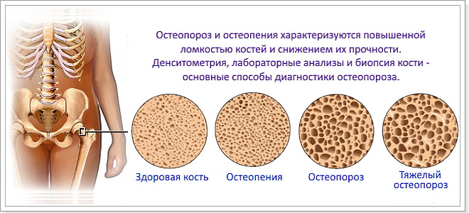 Остеопороз