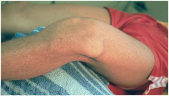 Реабилитация после эндопротезирования колена, возможные осложнения после операции Реабилитация после эндопротезирования колена